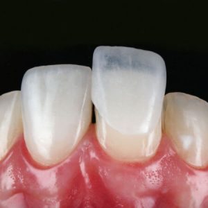 lente de contato dental