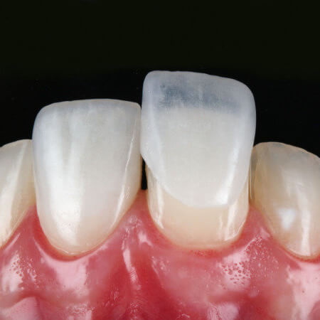lente de contato dental
